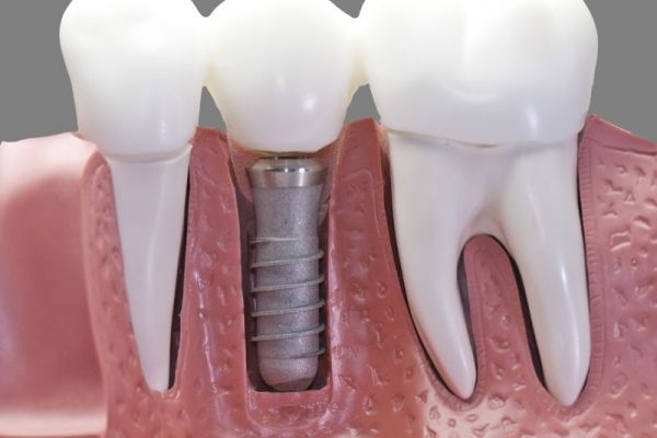 How does the dental implant process work?